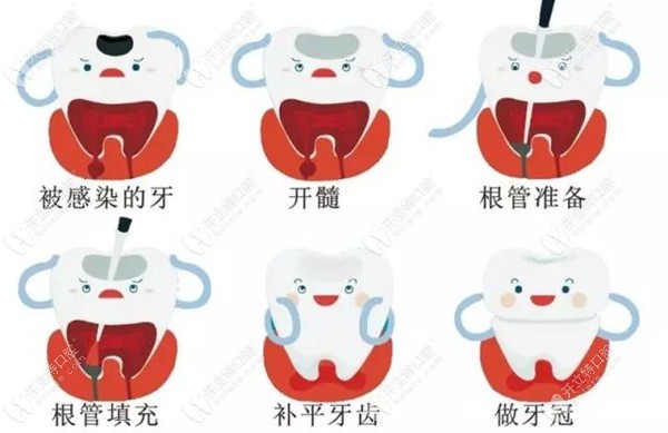 根管治療的過(guò)程演示