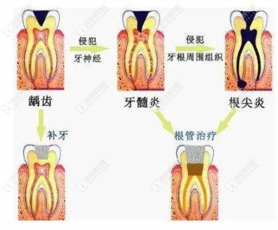 齲齒的治療方法