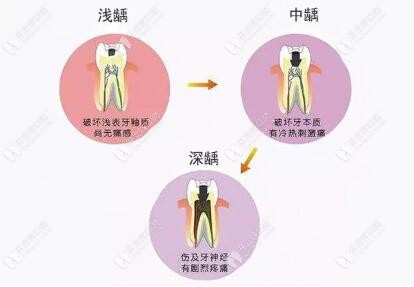 齲齒發(fā)展過(guò)程