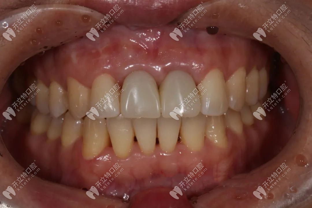 顧客臨時(shí)牙佩戴后情況 顧客臨時(shí)牙佩戴后情況