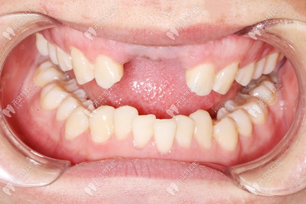 上門牙缺失兩顆,在廣州荔灣穗華口腔做了前牙美學(xué)種植修復(fù)