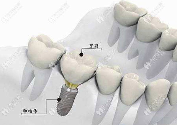 瑞士iti軟組織水平種植體與骨結(jié)合牙植體,哪個適合磨牙種植