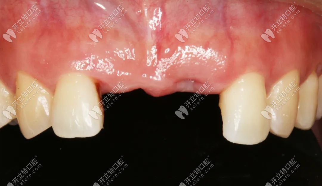 分享用愛爾創(chuàng)瓷倍健全鋯牙完成前牙修復(fù)的經(jīng)歷