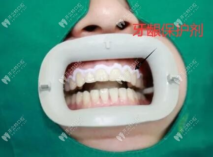 牙齒美白涂抹牙齦保護劑
