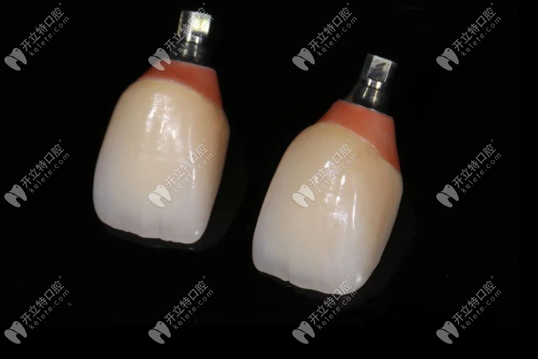 種植后長久性牙冠的修復(fù) 種植后長久性牙冠的修復(fù)